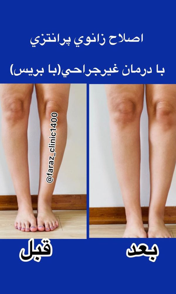 درمان پای پرانتزی با بریس