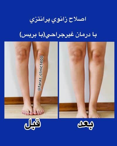 درمان پای پرانتزی با بریس