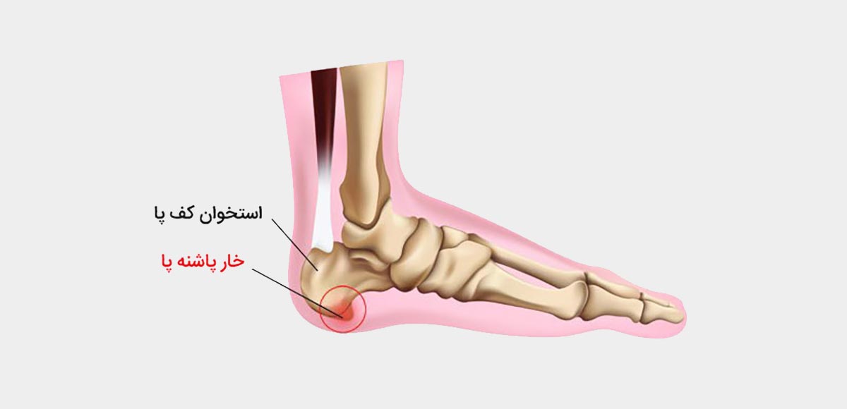 عکس خار پاشنه