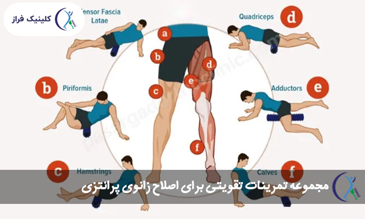 مجموعه تمرینات تقویتی برای اصلاح زانوی پرانتزی