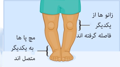 پای پرانتزی در کودکان