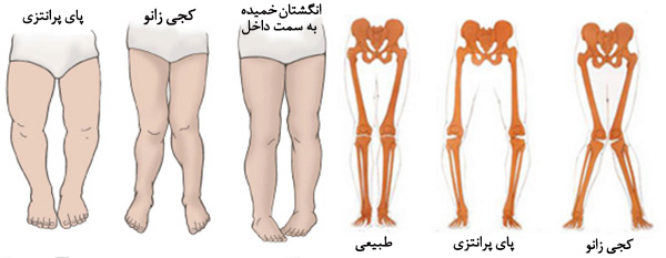 بیماری بلانت