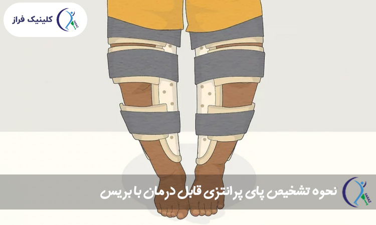 نحوه تشخیص پای پرانتزی قابل درمان با بریس