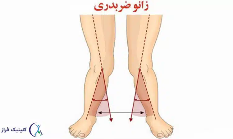 عکس زانوی ضربدری