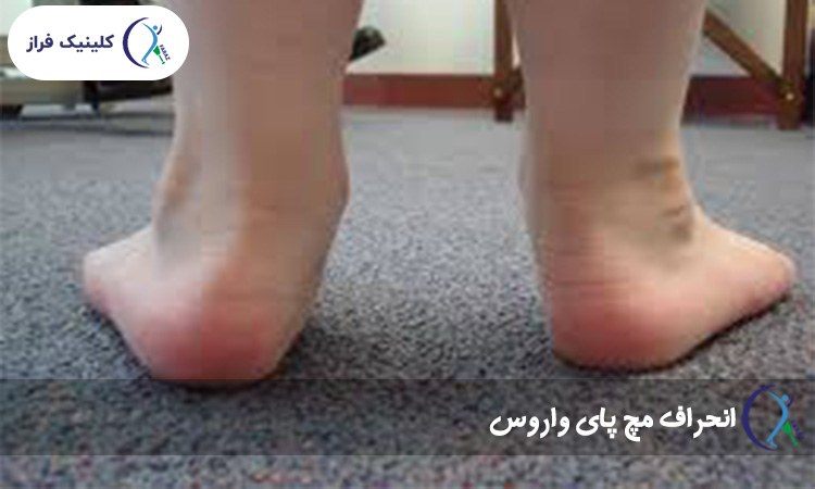 انحراف مچ پای واروس