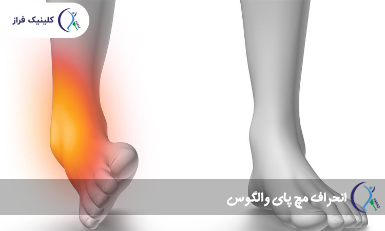 انحراف مچ پای والگوس