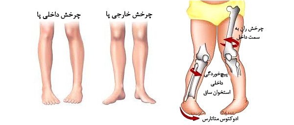 درمان چرخش مچ پابه داخل در کودکان
