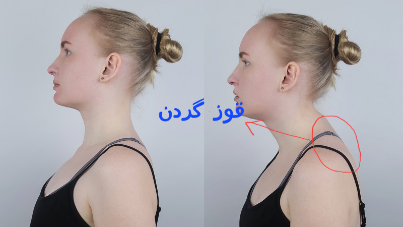 عوارض افتادگی شانه