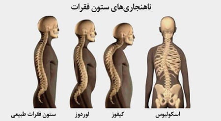 کیفوز و لوردوز