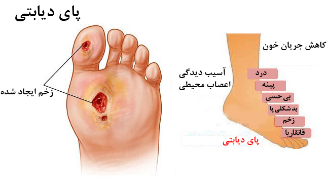دیابت و عوارض آن در پا