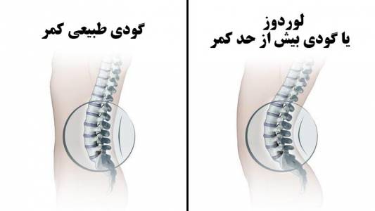 لوردوز چیست