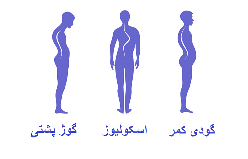انواع انحراف ستون فقرات