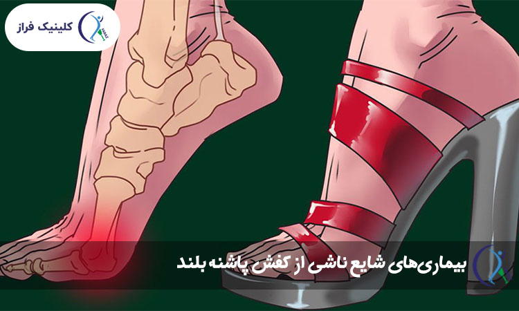 بیماری‌های شایع ناشی از کفش پاشنه بلند
