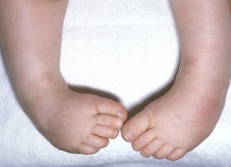 روش های درمان پا چنبری یا کلاب فوت در کودکان