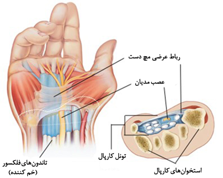 عکس سندرم تونل کارپال