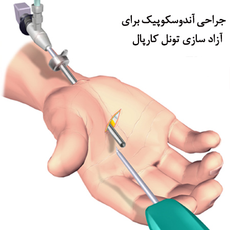 آرتروسکوپی مچ دست