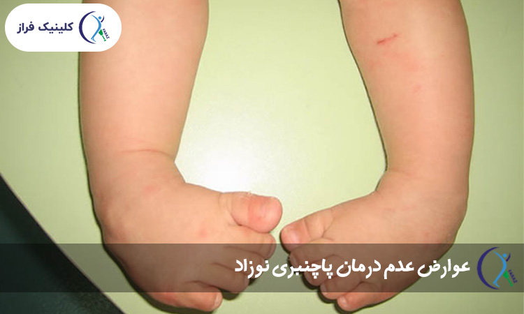 عوارض عدم درمان پاچنبری نوزاد