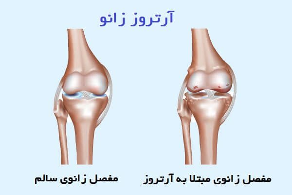 عکس ساییدگی زانو