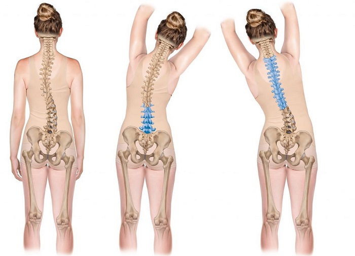 عضلات درگیر در اسکولیوز