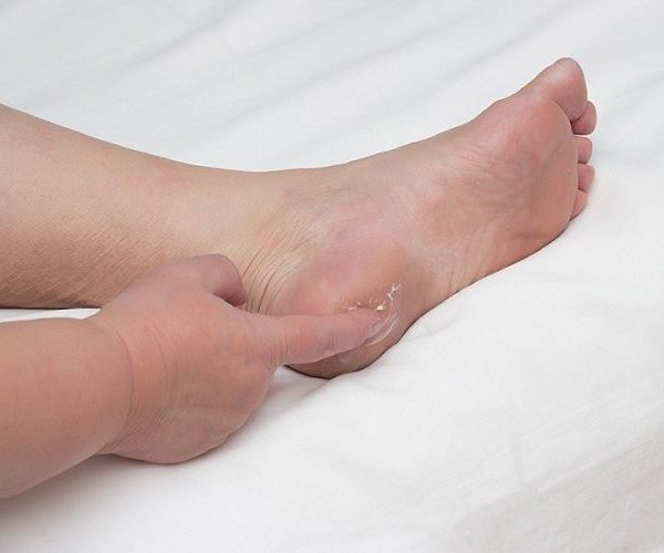 کفی طبی برای خار پاشنه