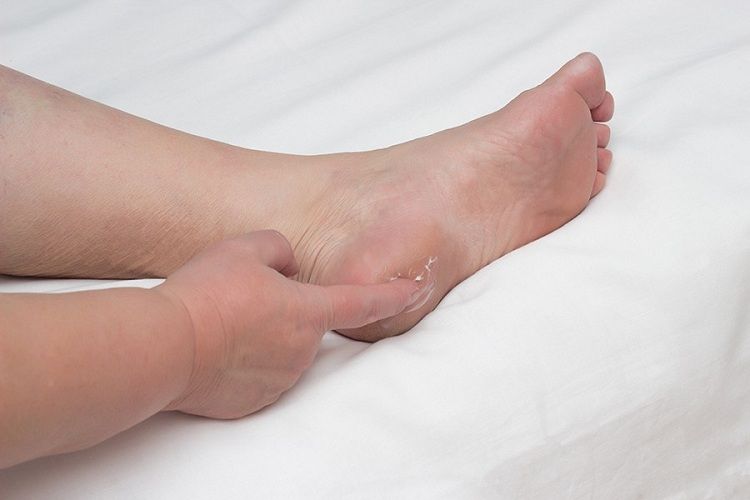 کفی طبی برای خار پاشنه