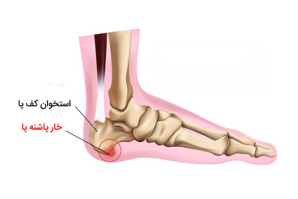 عکس خار پاشنه