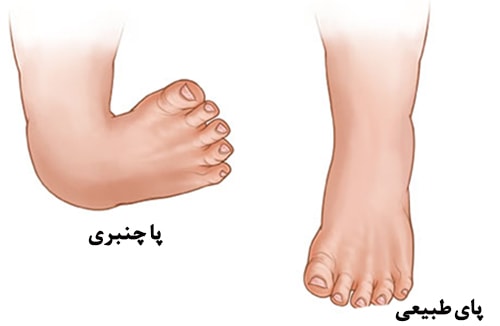 عکس پاچنبری