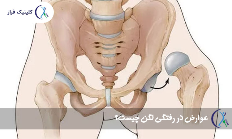 عوارض در رفتگی لگن چیست؟