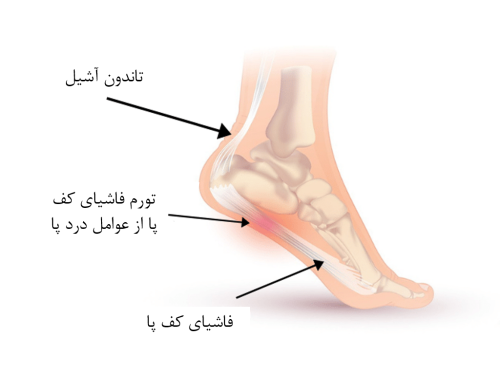 درد کف پا