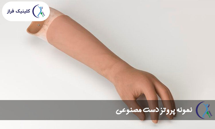 پروتز دست