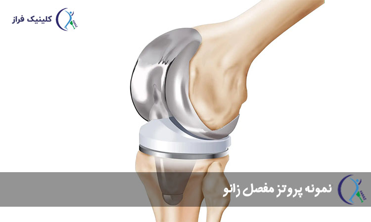 پروتز مفصل