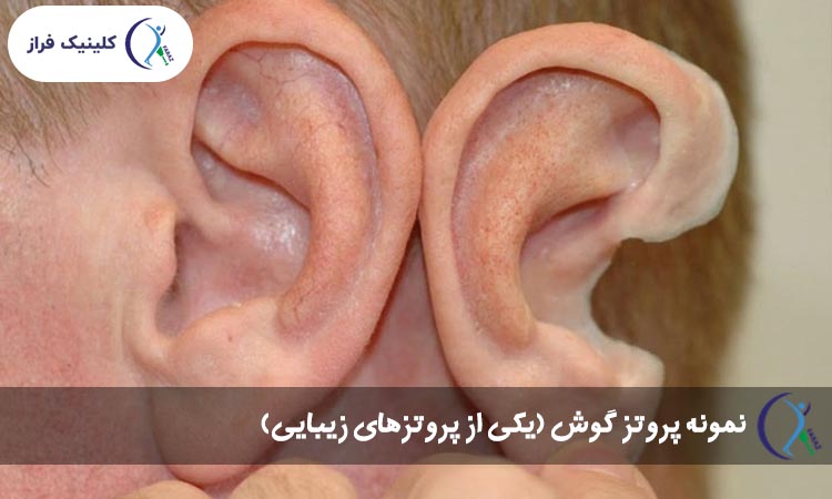 پروتز گوش