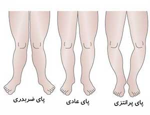 شکل طبیعی پای نوزادان