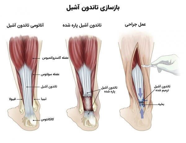 ترمیم پارگی تاندون آشیل