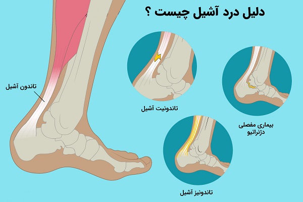 درد آشیل پا