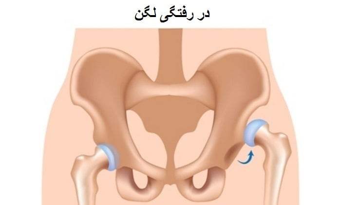 عکس در رفتگی لگن 
