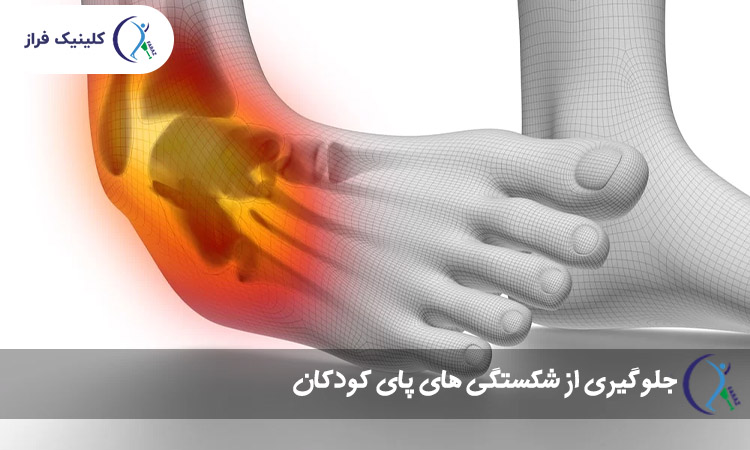 شکستگی پا یا پیچ‌خوردگی؟ (تفاوت علائم)