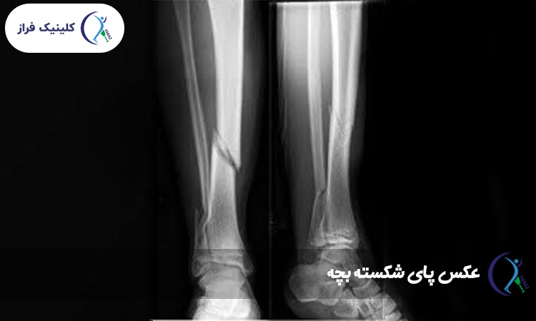 عکس پای شکسته بچه