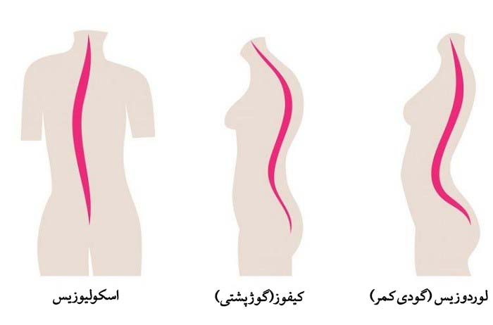 برآمدگی ستون فقرات