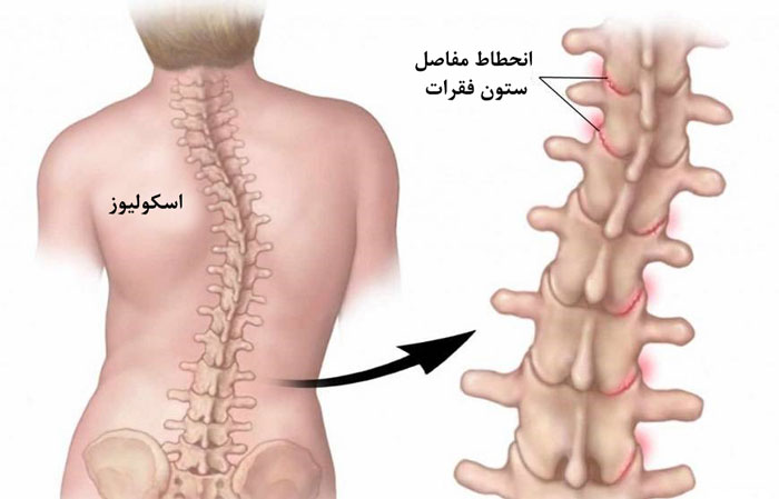 عکس انحراف ستون فقرات