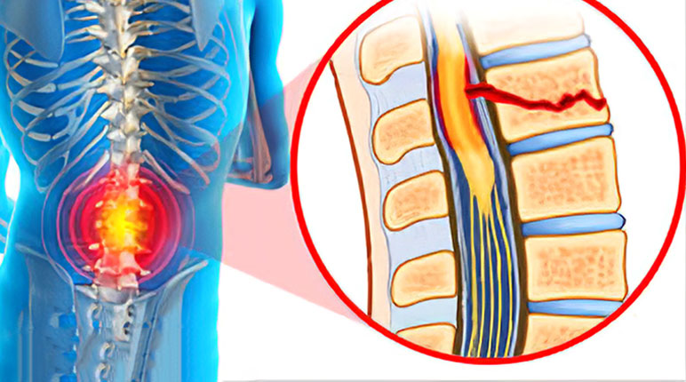 عکس ضایعه نخاعی