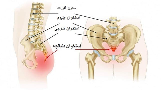 برآمدگی استخوان دنبالچه در کودکان