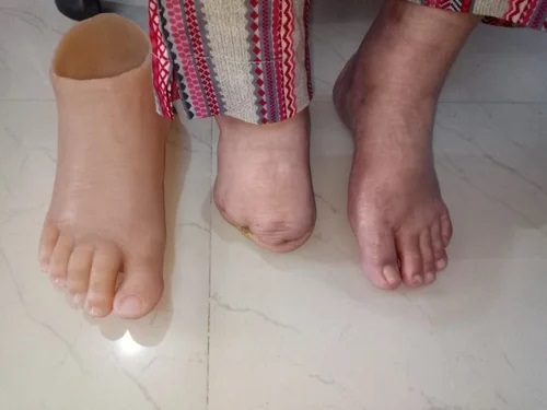 مراقبت و تمیز کردن پروتز