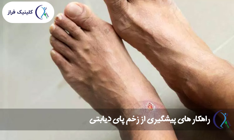 پیشگیری از زخم پای دیابتی