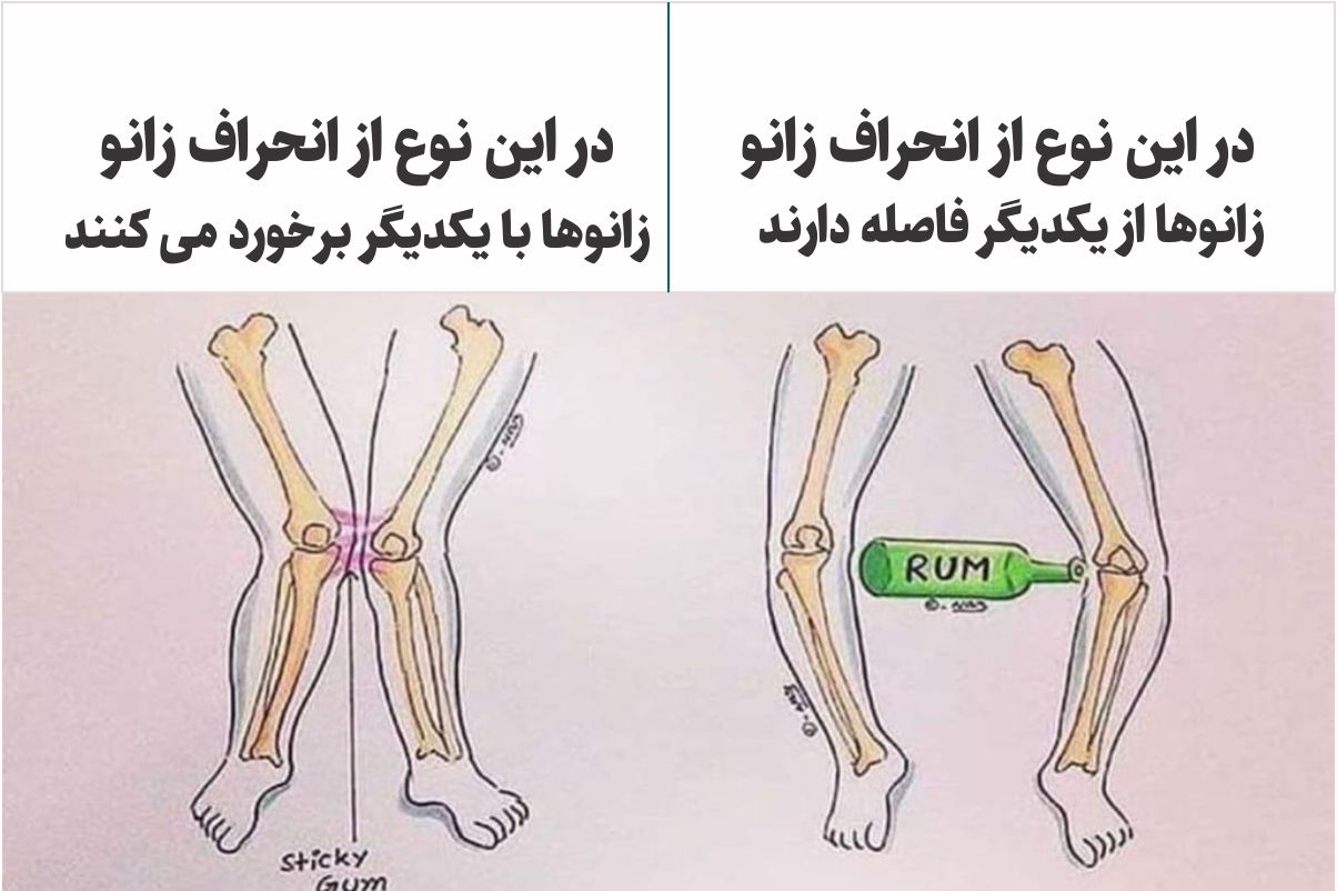 عکس انحراف زانو
