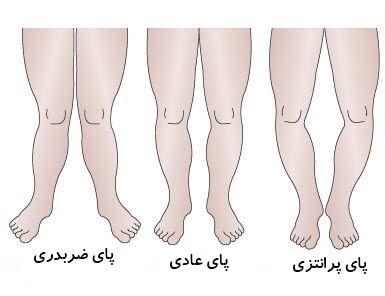 شکا طبیعی پای کودکان