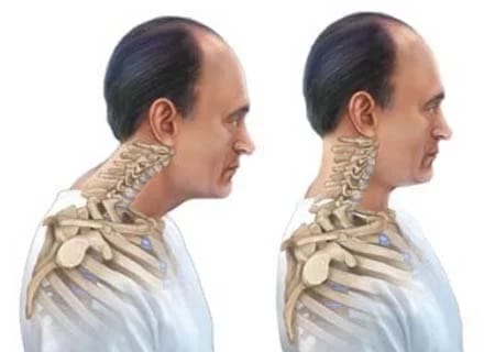 گردنبند طبی برای قوز گردن