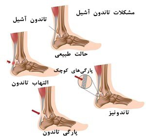 عکس تاندون آشیل
