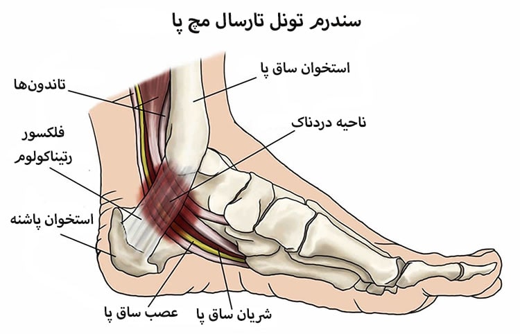 سندرم تونل تارسال