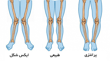 عکس پای پرانتزی